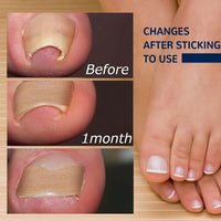 Thumbnail for Ingrown Nail Corrector - LightsBetter