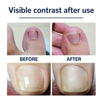 Thumbnail for Ingrown Nail Corrector - LightsBetter
