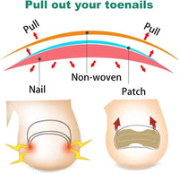 Thumbnail for Ingrown Nail Corrector - LightsBetter