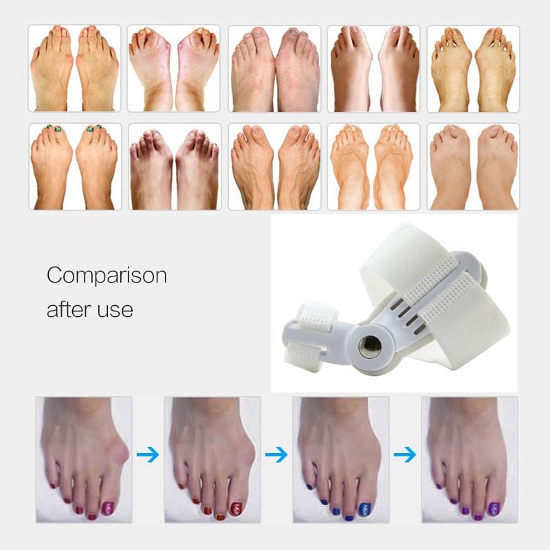 Bunion Corrector™ - LightsBetter