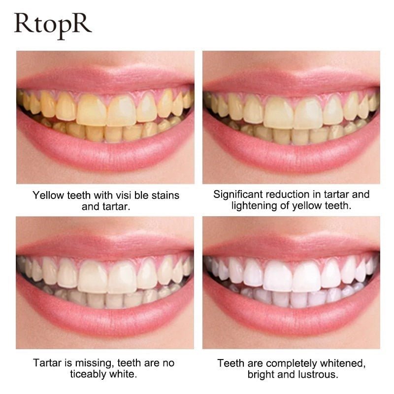 Teeth Whitening - LightsBetter