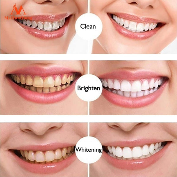 Teeth Whitening - LightsBetter
